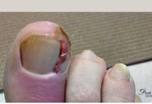 What Are the Risks of Ignoring Pus Under the Toenail