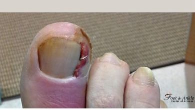 What Are the Risks of Ignoring Pus Under the Toenail