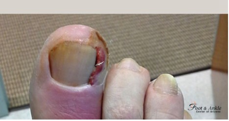 What Are the Risks of Ignoring Pus Under the Toenail