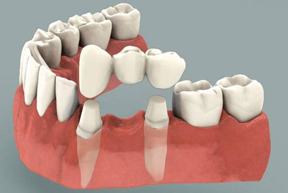 Dental Crowns And Bridges